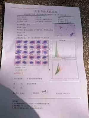 中国著名针灸专家 治疗肿瘤第一人 — 陈吉香