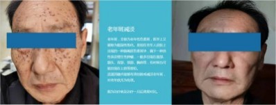 永球适温消融技术创始人  ——宁永球院长