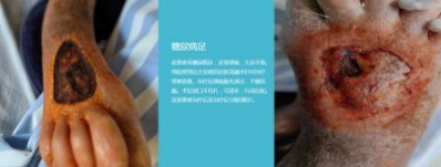 永球适温消融技术创始人  ——宁永球院长