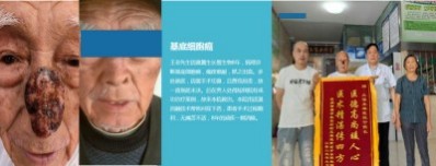 永球适温消融技术创始人  ——宁永球院长