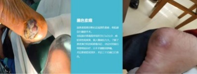 永球适温消融技术创始人  ——宁永球院长