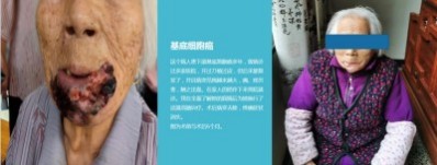 永球适温消融技术创始人  ——宁永球院长