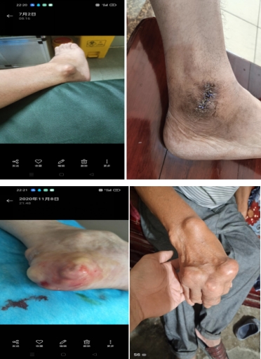 痛风结石老鼠疮乳腺增生无效退款 广西百色杨忠雅医师