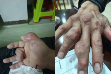 痛风结石老鼠疮乳腺增生无效退款 广西百色杨忠雅医师