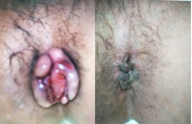 痛风结石老鼠疮乳腺增生无效退款 广西百色杨忠雅医师